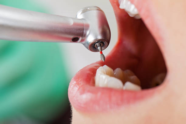 Best Emergency Wisdom Tooth Extraction in Bowdon, GA